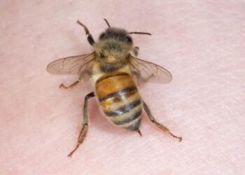 Tânără din Botoșani salvată în direct de un medic aflat la distanță: reacție anafilactică transmisă live pe internet